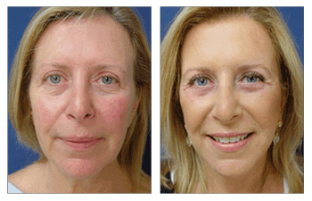 A woman's face before and after a facelift incorporating fat transfer. A woman's face before and after a facelift incorporating fat transfer.