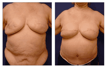 A woman's breast before and after Breast Reconstruction surgery. A woman's breast before and after Breast Reconstruction surgery.