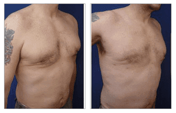 Tummy tuck before and after with botched gynecomastia correction. Tummy tuck before and after with botched gynecomastia correction.