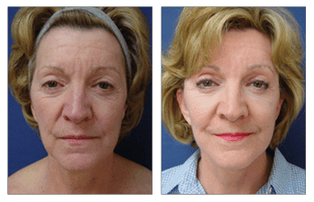 A woman's face undergoes a remarkable transformation through the utilization of fat transfer, offering an alternative to traditional facelift procedures. A woman's face undergoes a remarkable transformation through the utilization of fat transfer, offering an alternative to traditional facelift procedures.