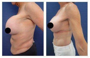 Airsculpt Liposuction vs VASER HD Lipo — patient photo
