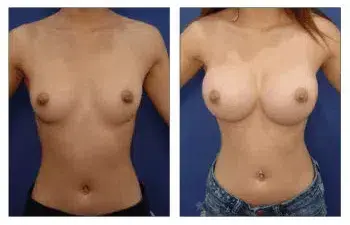 Free Natural Breast Augmentation with Liposuction 360 Free Natural Breast Augmentation with Liposuction 360