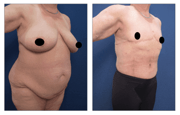 Transgender Breast Surgery Laguna Beach Transgender Breast Surgery Laguna Beach