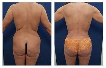 Tummy tuck and BBL surgery before and after. Tummy tuck and BBL surgery before and after.