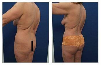 How to avoid skin redundancy following high definition body contouring — patient photo How to avoid skin redundancy following high definition body contouring — patient photo