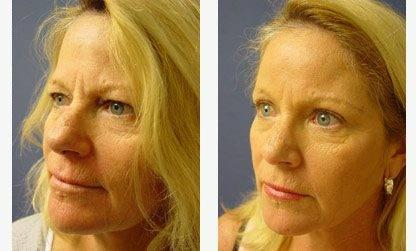 brow-lift-patient-2-front-left