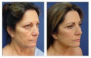 Explore the incredible results of a tummy tuck procedure through before and after images.