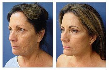 A woman's breast before and after surgery for breast augmentation.