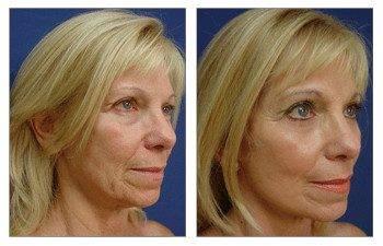 GMommy Lip Lift — before and after results