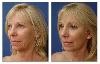 GMommy Lip Lift — before and after results