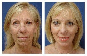 GMommy Lip Lift GMommy Lip Lift