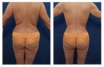 Tummy tuck before and after - What is Expansion vibratory Lipofilling? Tummy tuck before and after - What is Expansion vibratory Lipofilling?