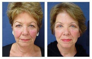 GMommy Upper Eyelid Blepharoplasty GMommy Upper Eyelid Blepharoplasty