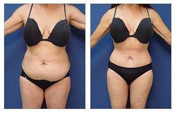 GMommy Tummy Tuck GMommy Tummy Tuck