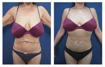 Eliminating Upper Abdominal Skin Rolls with Tummy Tuck Eliminating Upper Abdominal Skin Rolls with Tummy Tuck