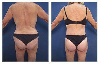 GMommy Lateral Thigh Tuck — #SS351 GMommy Lateral Thigh Tuck — #SS351