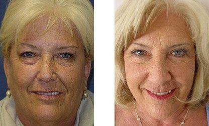 GMommy Lower Eyelid Blepharoplasty GMommy Lower Eyelid Blepharoplasty