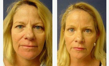 GMommy Browlift GMommy Browlift