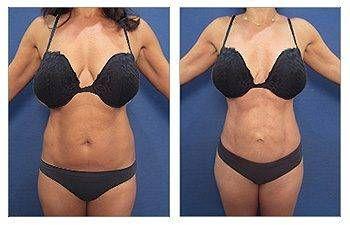 GMommy Breast Lift GMommy Breast Lift