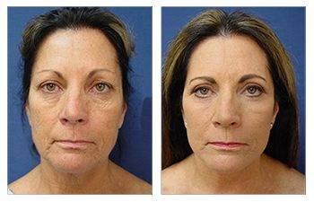 A woman's breast before and after High Definition Liposuction surgery. A woman's breast before and after High Definition Liposuction surgery.