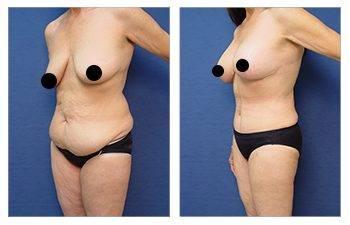 A woman with tattoos showcasing her stunning before and after breast augmentation transformation during Mommy Makeover Specials. A woman with tattoos showcasing her stunning before and after breast augmentation transformation during Mommy Makeover Specials.