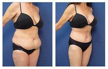 GMommy Makeover Medial Thigh Tuck GMommy Makeover Medial Thigh Tuck