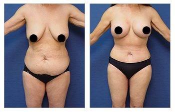 A woman's breast before and after Mommy Makeover surgery, addressing upper belly fullness. A woman's breast before and after Mommy Makeover surgery, addressing upper belly fullness.