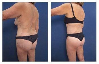 GMommy Upper Body Lift GMommy Upper Body Lift