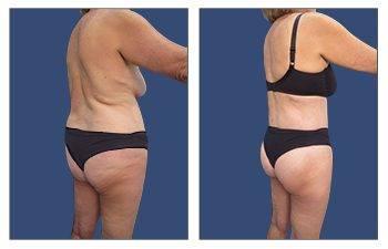 GMommy Upper Body Lift GMommy Upper Body Lift