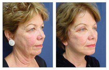 A woman's breasts before and after HD Liposuction surgery.