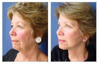 GMommy Upper Eyelid Blepharoplasty GMommy Upper Eyelid Blepharoplasty