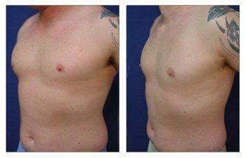 Gynecomastia Gynecomastia