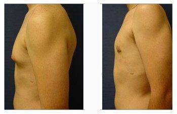 gynecomastia surgery scars