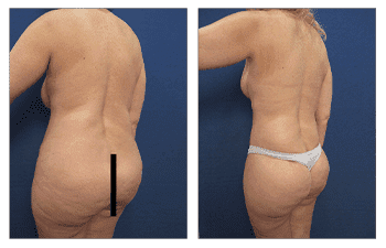 Is it worth getting a tummy tuck revision before and after? Is it worth getting a tummy tuck revision before and after?