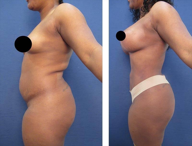 High Definition Body Sculpting Cost — before and after results High Definition Body Sculpting Cost — before and after results