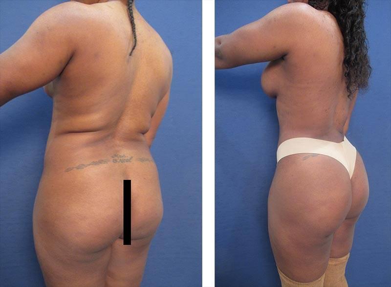 High Definition Body Sculpting Cost