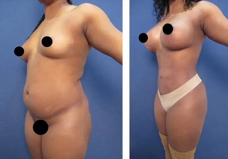 High Definition Body Sculpting Cost — photo 2 High Definition Body Sculpting Cost — photo 2 | SurgiSculpt®