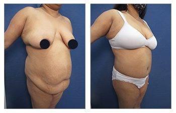 HD Lipo 360 Body Contouring for the Massive Weight Loss Patients — patient photo