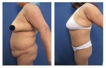 A woman's breast before and after a corrective surgery for operated-looking breasts.