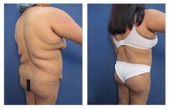 HD Lipo 360 Body Contouring for the Massive Weight Loss Patients — patient photo