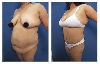 A woman's breast before and after Breast Augmentation surgery.