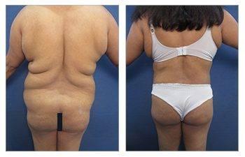 HD Lipo 360 Body Contouring for the Massive Weight Loss Patients