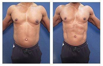 High Definition Abdominal Contouring High Definition Abdominal Contouring