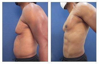 High Definition Abdominal Contouring High Definition Abdominal Contouring