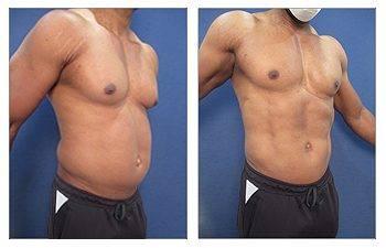 High Definition Abdominal Contouring High Definition Abdominal Contouring