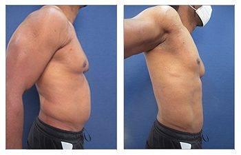 High Definition Abdominal Contouring for the Large Weight Loss Male Patient High Definition Abdominal Contouring for the Large Weight Loss Male Patient