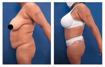 High Definition Body Contouring for the Plus-size Patient