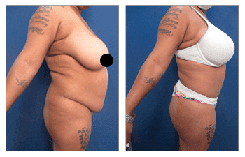 body contouring for plus size patient