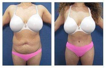 Body Contouring — #SS114 Body Contouring — #SS114