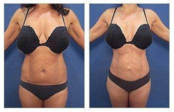 Mini Tummy Tuck + Lipo Revision — #SS058 Mini Tummy Tuck + Lipo Revision — #SS058